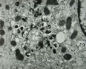 M,8y. | Wilson disease susp. M,8y. | Wilson disease susp.